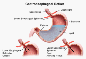 Gastroesophageal