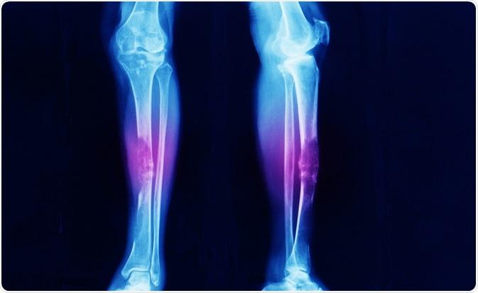 Understanding Bone Cancer and its treatment