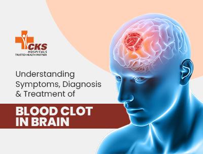 A Guide to Symptoms, Causes, and Treatment of Brain Blood Clots